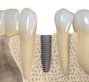 3 Wskazania Aby uzyskać więcej informacji na temat wskazań i przeciwwskazań związanych z poszczególnymi implantami, należy zapoznać się z odpowiednimi instrukcjami obsługi, które można znaleźć na www.