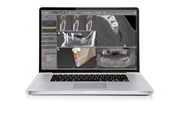 0.4 mm Koronowo-wierzchołkowa pozycja implantu Implanty Straumann umożliwiają elastyczne pozycjonowanie platformy, w zależności od indywidualnych cech anatomicznych, miejsca implantacji oraz rodzaju