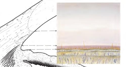 Gonioskopia. Podręcznik i atlas Ryc. 5.13. Silniejsza pigmentacja kąta niż przedstawiona na ryc. 94. Barwnik zasłania większość szczegółów anatomicznych kąta i pokrywa powierzchnię tęczówki Ryc. 5.14.