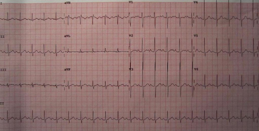 EKG