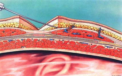 pre- I operacja II okres pooperacyjny Total mean tramadol requirement in the postoperative period.