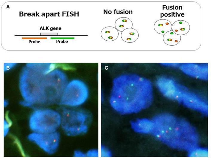Zasada interpretacji wyniku FISH w ocenie rearanżacji genu ALK