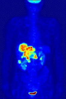 Pozytonowa tomografia emisyjna, PET ( positron emission tomography,) technika, w której rejestruje się promieniowanie
