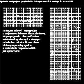 Interpretacja zapisów EKG z komentarzami 26. Rytm ze stymulatora o częstości 80/min. Stymulacja i sterowanie prawidłowe.