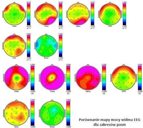 EEG/QEEG Zebrane informacje z zapisu EEG z 21 kanałów można zastosować do tworzenia tzw.