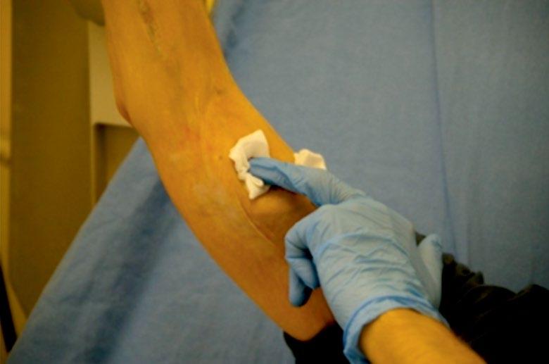 Sposób użycia opatrunku Woundclot do tamowania krwawienia po dializie doświadczenia własne Etapy Działania 1 Zakończyć zabieg dializy zgodnie z