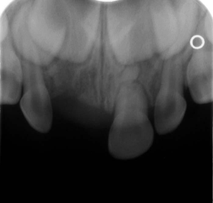 anatomicznej zęba mlecznego, gdyż korony zębów mlecznych są krótsze w stosunku do koron zębów stałych, a korzenie zębów mlecznych mają mniejsze wymiary (3).