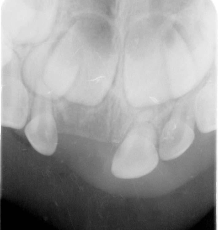 Zachowawcze postępowanie w przypadku złamania korzenia w mlecznym zębie siecznym opis przypadku Podczas kolejnych wizyt kontrolnych odbywających się co pół roku stwierdzano ruchomość fizjologiczną
