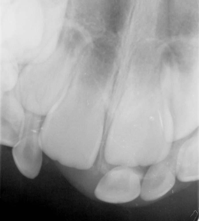 W wielu przypadkach złamania w przywierzchołkowej części korzenia zębów mlecznych są bezobjawowe i nie zostają zdiagnozowane.