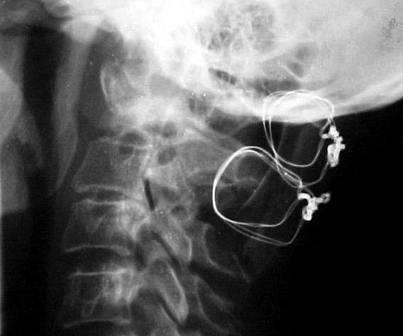 Zapewnienie ciszy biomechanicznej Po stabilizacji może