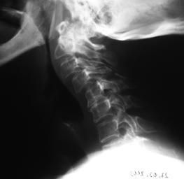 spondylozie plus