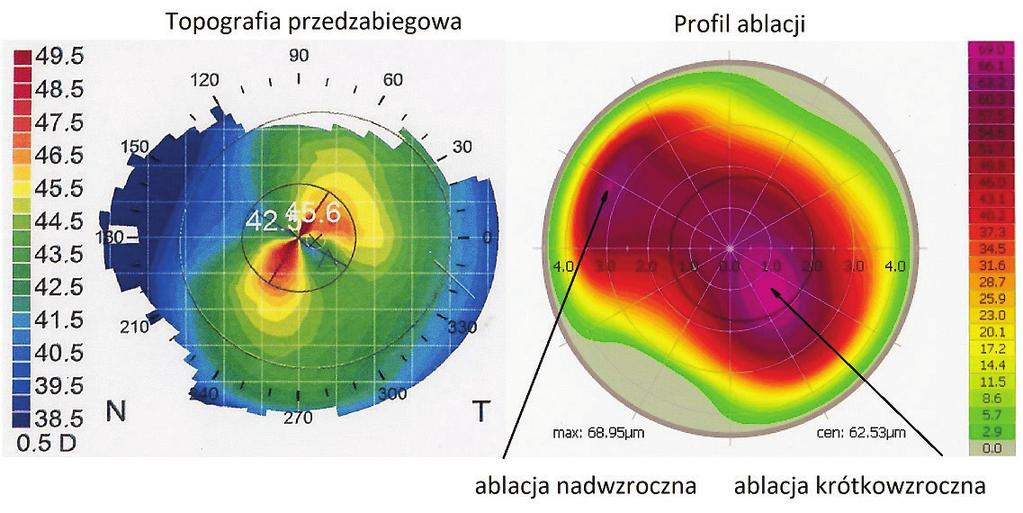 Procedury chirurgii refrakcyjnej oparte na topografii rogówki Zabiegi wykorzystujące ablację oparte na topografii rogówki były pierwotnie tzw. procedurami naprawczymi.