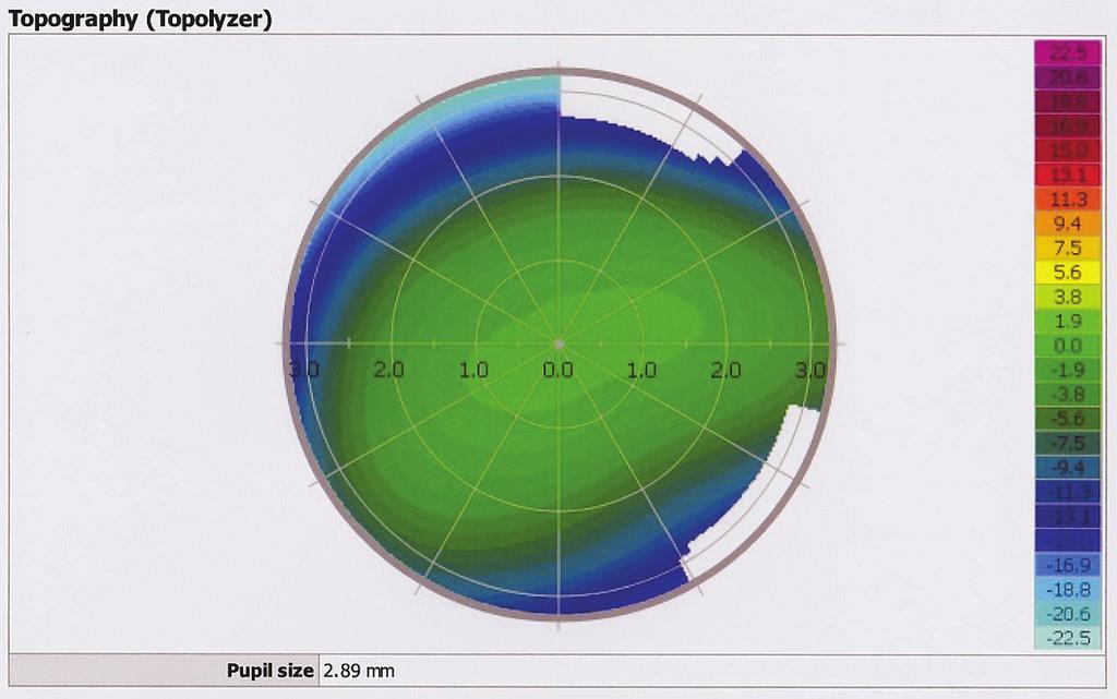 ContouraTM Vision laserowa korekcja wad wzroku o najwyższym stopniu personalizacji RYCINA 5 Wynik badania topograficznego: K1 = 43,72@16, K2 = 44,41@106; astygmatyzm 0,61 D w osi 17,9 ; asferyczność