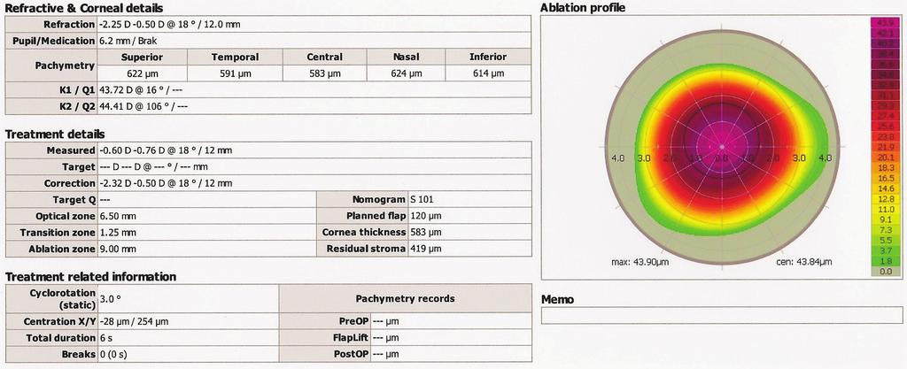 W opisywanym przypadku największa głębokość ablacji wynosi 8 µm, co odpowiada korekcji wady ok. 0,5~0,6 D.