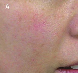 Ryc. 3. Redukcja drobnych naczyń na twarzy za pomocą lasera KTP 532 nm z kontaktowym chłodzeniem skóry. Kobieta w wieku 30 lat (A), pojedynczy zabieg.