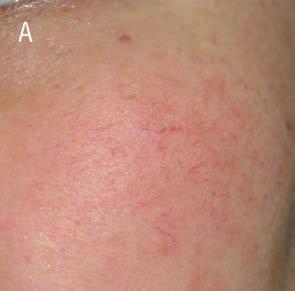 Ryc. 5. Redukcja drobnych naczyń na twarzy za pomocą lasera KTP 532 nm z kontaktowym chłodzeniem skóry. Kobieta w wieku 32 lat (A), pojedynczy zabieg.