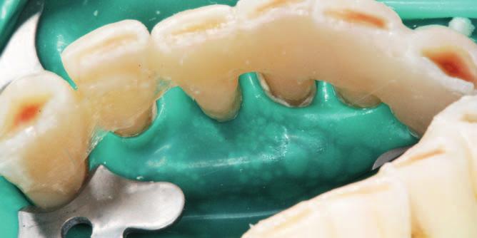 Nauczono pacjenta, jak posługiwać się nicią Super Floss Oral B, termin kontroli wyznaczono za 3 tygodnie (fot. 16).