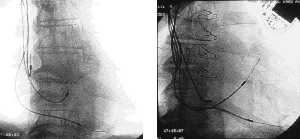 Folia Cardiologica Excerpta 2007, tom 2, nr 7 Aktualny stan wiedzy na temat następstw stymulacji wierzchołkowej szczegółowo omówił Kutarski w pracy z 2005 r. [16].