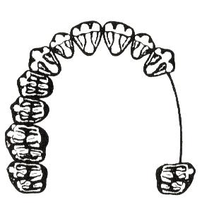 Zadanie 10. Na którym rysunku przedstawiono III klasę braków zębowych według Kennedy ego? Zadanie 11.