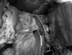 U ycie bipolarnego systemu zamykania naczyƒ ThermoStapler w histerektomii pochwowej W grupie pacjentek operowanych z u yciem systemu ThermoStapler hemostaza by a zadowalajàca i nie by o potrzeby zak