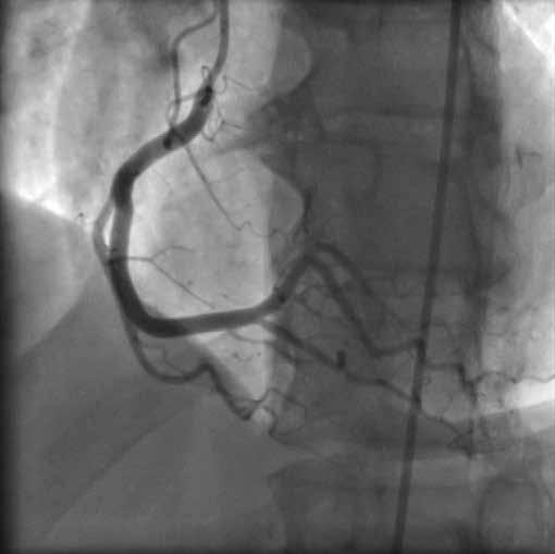 piersiowej była zaliczana do kardiologicznego zespołu X (CSX, cardiac syndrome X), który jest chorobą o złożonym i różnorodnym charakterze zarówno pod względem patofizjologicznym, jak i klinicznym.