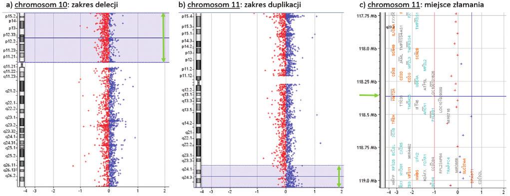 Diagn Lab. 2018; 54(4): 225-232 Rycina 4. Wynik analizy metodą mikromacierzy cytogenetycznych w kierunku detekcji zmian w liczbie kopii materiału genetycznego.