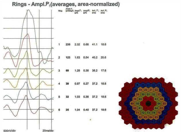 8. mferg (multifocal ERG= wieloogniskowy elektroretinogram) pochodzenie komórkowe: Mapa funkcji bioelektrycznej systemu czopkowego (czopek+ kom. dwubiegunowa) z 60 centralnych stopni kątowych.