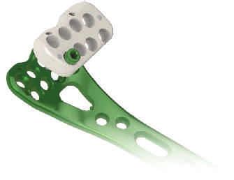 4,0ChLP PŁYTKA PROMIENIOWA DALSZA DŁONIOWA WĄSKA 4.0ChLP DISTAL RADIUS VOLAR NARROW PLATE 4,0ChLP ПЛАСТИНА ЛАДОННАЯ ДЛЯ ЛУЧЕВОЙ КОСТИ УЗКАЯ ДИСТАЛЬНАЯ 1:1 2.0 L R Non * Len L R 4 59 3.7069.604 3.7070.