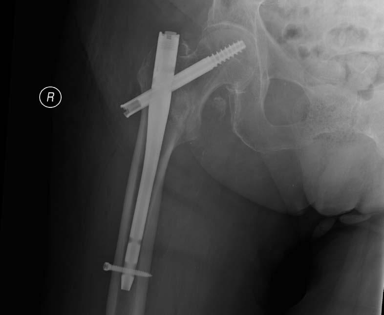 instrumentarium do przeprowadzenia implantacji oraz usunięcia implantów po zakończonym okresie leczenia, instrukcja użytkowania instrumentarium.