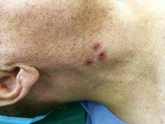 WWRyc. 1. Zmiany zapalne skóry w miejscu po usuniętym cewniku stanowiące przeciwwskazanie do implantacji dostępu długoterminowego w tym miejscu. WWRyc. 2. Przedoperacyjne badanie usg żył szyjnych.