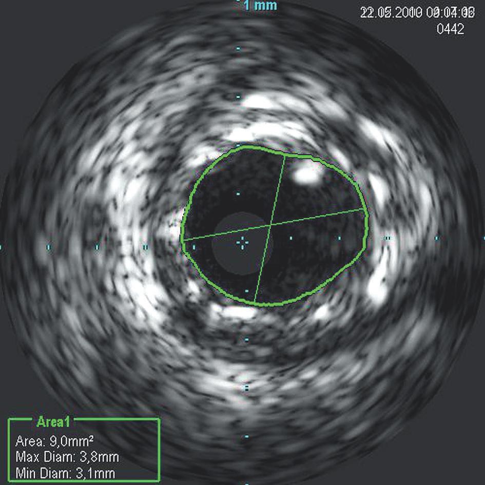 Andrzej Szczepański et al. DEB for in-stent restenosis in left main with later OCT control Ryc. 3. Kontrola ICUS po dwukrotnej predylatacji balonowej pole powierzchni światła naczynia 9,0 mm2 Fig. 3. ICUS assessment post double baloon expansion lumen cross section area 9.