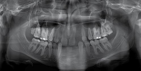 Badania kliniczne / Clinical research M. Zadurska et al. Ryc. 1. Pantomogram 16-letniego pacjenta z oligodoncją uzębienia stałego.