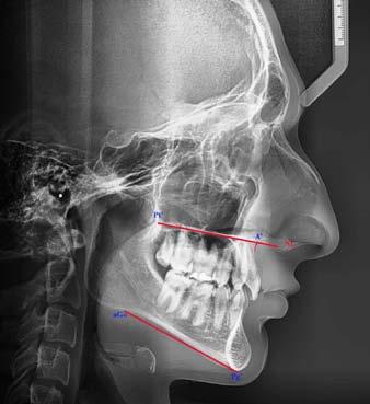 Visible hypoplasia of the maxillary and mandibular alveolar process. Ryc. 2. Pomiary długości szczęki i trzonu żuchwy na zdjęciu cefalometrycznym 16-letniego pacjenta z oligodoncją uzębienia stałego.