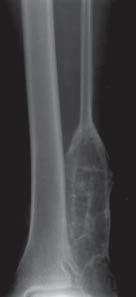 84 E. KULETA-BOSAK, E. KLUCZEWSKA, W. MADZIARA, J. MACHNIK-BRONCEL several weeks to several months [12].