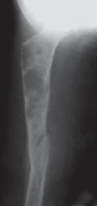 reaction of the periosteum, relationship of the bone to the soft tissue. Sometimes, the radiological image reveals characteristics of a benign lesion and permits a diagnosis.