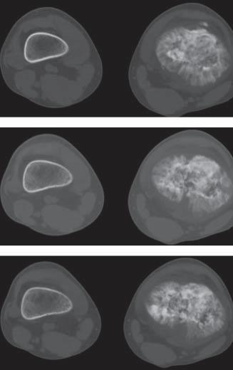 tumors calcifications and heterotopic bone formation are clearly contoured. Complications include fractures or pathological fractures. The image of the remaining bone is normal.