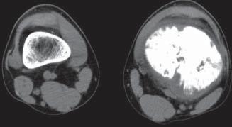86 E. KULETA-BOSAK, E. KLUCZEWSKA, W. MADZIARA, J. MACHNIK-BRONCEL tinuum, appearance of Codman s triangle and malignant reactions of the periosteum (layering, spicules).