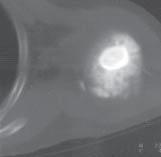 Multi-plane image reconstructions, carried out on multirow detector CTs allow for a better visualization of the primary focal area [22, 24, 25].