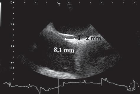 Transoesophageal echocardiography can help distinguish patient INTRODUCTION Patent foramen ovale (PFO) is the most common type of interatrial communication, found in about 26% (range 17 35%) of the
