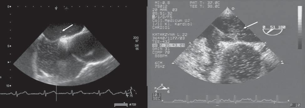 Monika Komar et al. A B Figure 2. Transoesophageal echocardiography using agitated saline contrast. Longitudinal biatrial/bicaval view. A. Passage of single contrast bubbles from the right to the left atrium is seen (arrow).