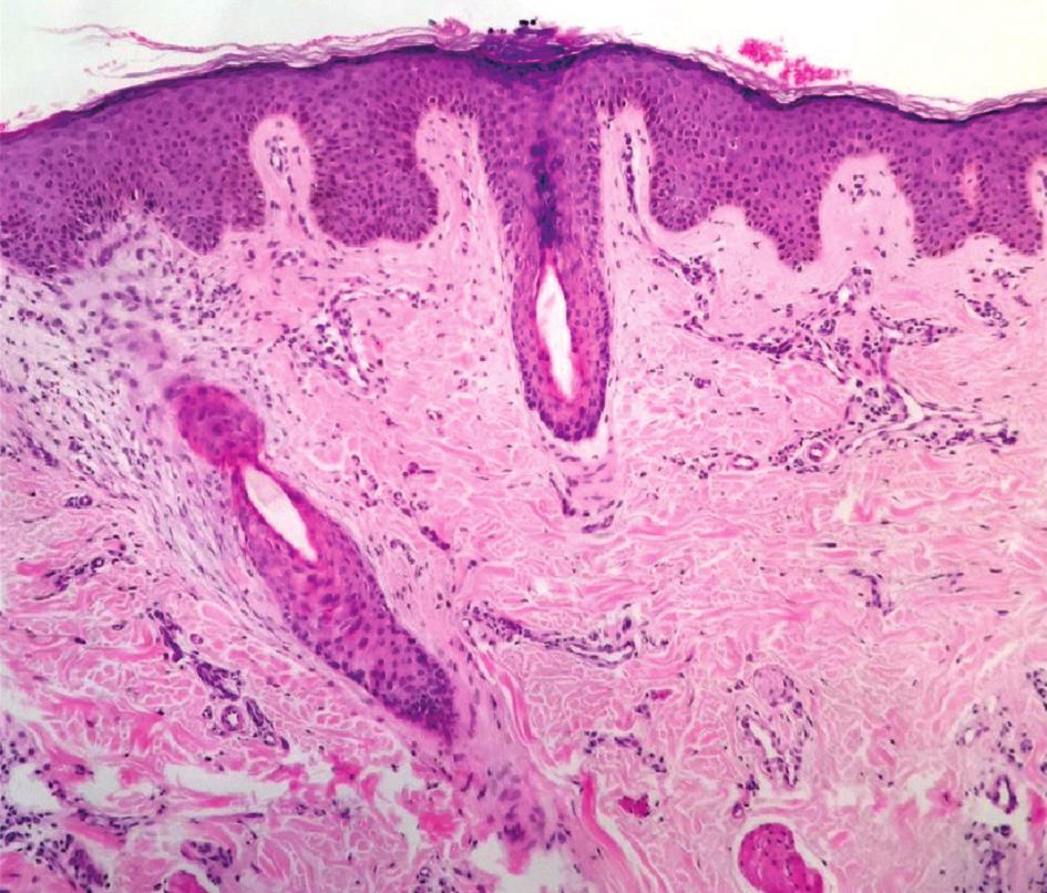 E, 100 ) besides the absence of sebaceous lobes, fusion of follicular structures, perifollicular fibroplasia and follicular/perifollicular inflammation (B H + E, 100 ).