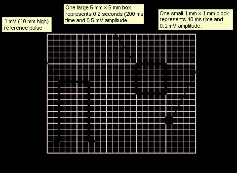 ECG graph