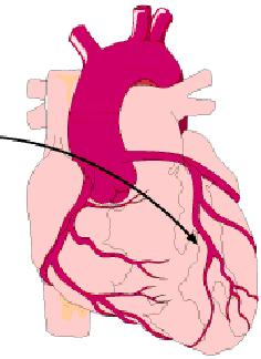 Myocardial infarction