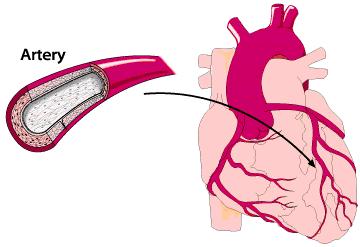 Heartpoint 100 000 heart