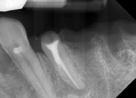 Następnie udrożniono i chemomechanicznie opracowano kanał za pomocą instrumentów palcowych: pilników oraz pilników C-file, oraz narzędzi maszynowych Protaper Gold: 14/60/06.