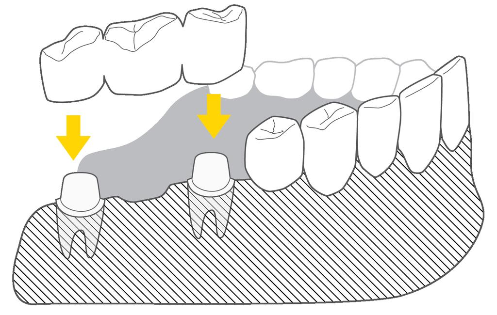 Mosty protetyczne Mosty protetyczne pozwalają na odbudowę brakujących zębów wykorzystując pozostałe, własne zęby Pacjenta.