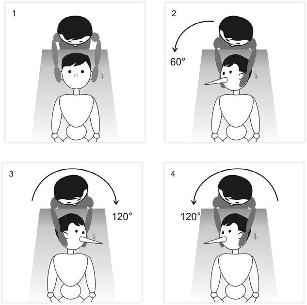 Rycina 5. Obrotowy test w leżeniu na wznak (supine roll test): 1. Pacjent leży na leżance. 2. Skręcamy głowę pacjenta o 60 w stronę prawą.