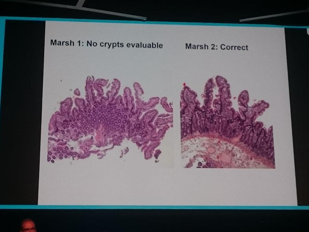 HISTOLOGIA Dzieci z podejrzeniem celiakii z pozytywnymi przeciwciałami anty-ttg-iga z 3 ośrodków w Finlandii i Rumunii (n=163,