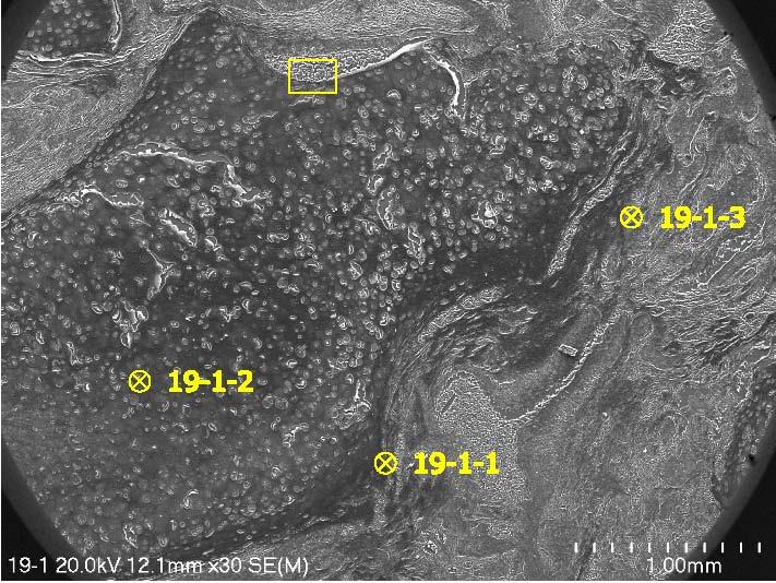 Fot. 4. Carcinoma planoepitheliale 1.3.1 wg WHO. Punkty zaznaczone na żółto miejsca wykonania analiz chemicznych metodą EDS. Mikroskop skaningowy, powiększenie wg skali (Pawlikowski 2013a). Tab.