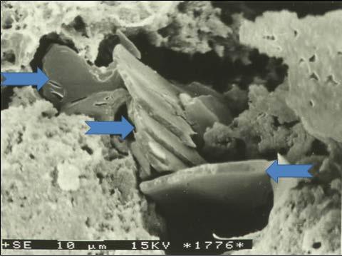 Fot. 2 Kryształy cholesterolu zawierające domieszkę fosforanów (kryształy o mieszanej budowie organiczno-nieorganicznej) krystalizujące w centrum krystalizacji tj.